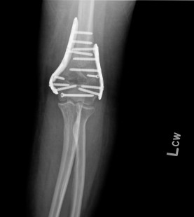 bionic elbow
